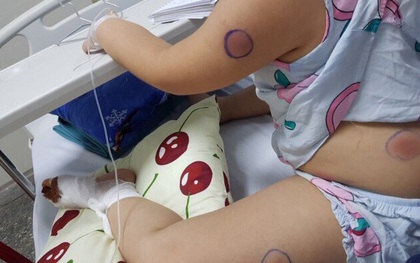 Gà mổ vào chân, bé gái bị nhiễm khuẩn “ăn thịt người”