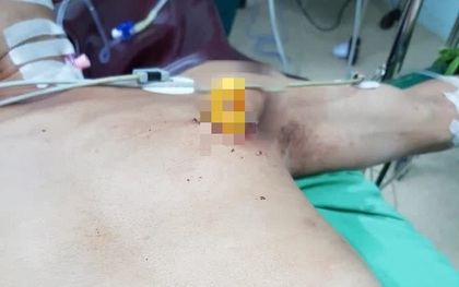Phẫu thuật cứu sống một bệnh nhân bị dao găm vào ngực