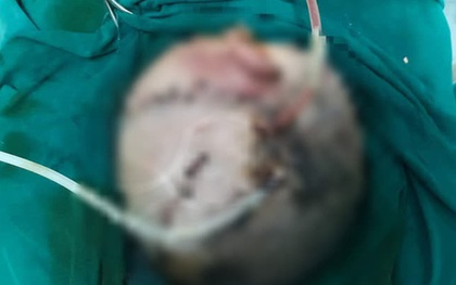 Bé trai hơn 4 tuổi bị chó nhà cắn tổn thương nặng vùng đầu