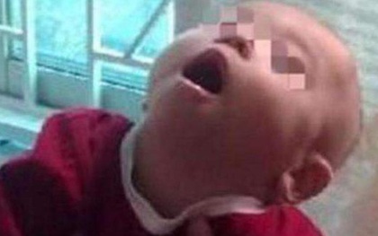 Bé gái 8 tháng tuổi bị bại não vì ông bà nội bế trên tay rung lắc cho cháu ngủ trong một thời gian dài