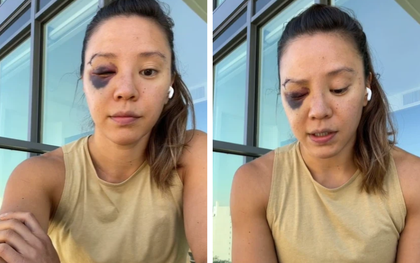 Nữ lực sĩ vỡ xương hốc mắt sau khi bị một tên cướp dùng búa tấn công ngay trên phố, fan xót xa khi chứng kiến diện mạo hiện tại của cô nàng