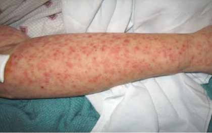 Dịch sốt virus Chikungunya bùng phát tại 13 tỉnh ở Campuchia