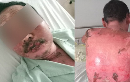 Dị ứng thuốc trị gout, người đàn ông bong tróc da toàn thân