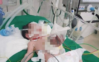 Nghệ An: Cứu sống bé sơ sinh có nội tạng nằm ngoài ổ bụng