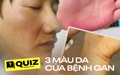 Quiz: Có 3 màu sắc "vàng, đỏ, đen" trên da, đừng chỉ nghĩ là bệnh ngoài da, đó có thể là dấu hiệu cảnh báo bệnh về gan