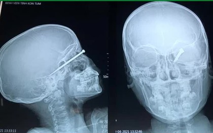 Bé trai 8 tuổi bị mũi tên bắn xuyên mắt, găm sâu vào sọ não