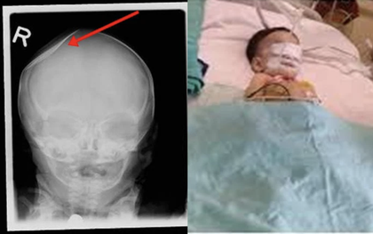 Bé 8 tháng vào viện với hộp sọ bị NỨT, 4 tháng sau cảnh sát bắt giữ 2 thủ phạm là kẻ không ai ngờ với thái độ thờ ơ đáng sợ