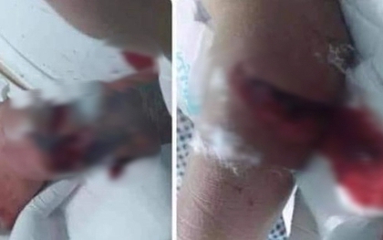 Thái Bình: Chém trọng thương bố, cậu bạn gái trong ''bữa cơm ra mắt"