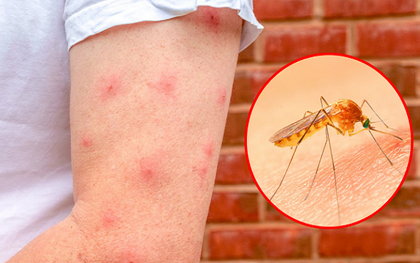 Giới khoa học khẳng định: Người hay bị muỗi cắn là do mùi cơ thể