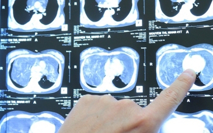 Cắt khối u 4 kg đè lên toàn bộ phổi khiến nữ bệnh nhân khó thở