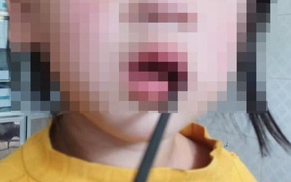 Bé gái 4 tuổi bị thanh sắt dài 20cm đâm vào khoang miệng