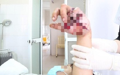 Thiếu niên bị nát bàn tay, lộ xương vì pháo tự chế