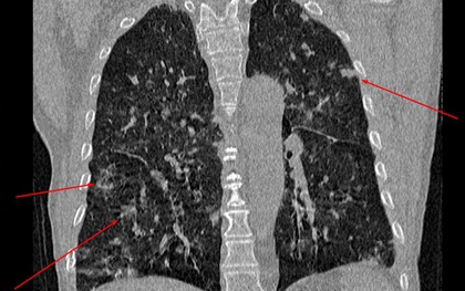 Phổi đông đặc sau 20 ngày khỏi Covid-19