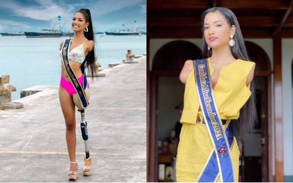 Bị điện giật mất 2 tay và 1 chân từ nhỏ, 20 năm sau cô gái với nghị lực phi thường trở thành mỹ nhân khiến cả thế giới ngưỡng mộ