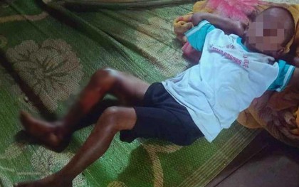 Điều tra nghi án bé trai bị tẩm xăng đốt hai chân vì không chịu đi trộm trái cây