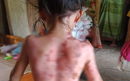 Phú Thọ: Công an "vào cuộc" vụ bé gái bị hàng xóm dội cả ấm nước sôi vào người