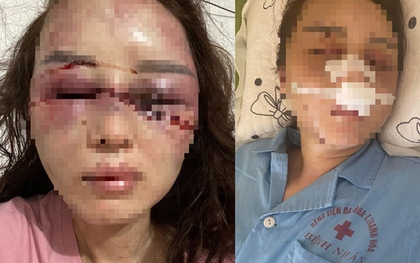 Cán bộ QLTT đánh đập bạn gái dã man vì hát song ca đã có vợ con