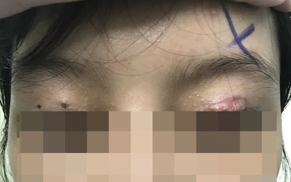 Làm đẹp ở cơ sở thẩm mỹ chui, nhiều phụ nữ tổn thương mắt nghiêm trọng