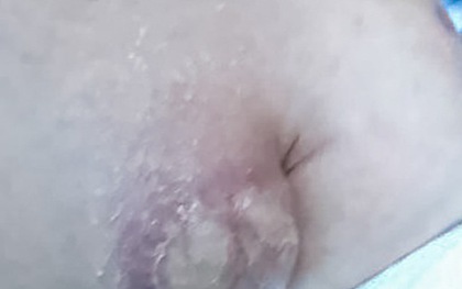 Ớn lạnh khối hạch ăn sâu vào nách sau tiêm vắc xin lao