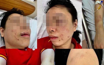 Người phụ nữ ở Hà Nội tố bị chồng cũ "bắt cóc", đánh đập dã man