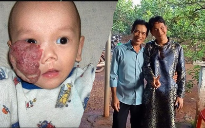 Cuộc hồi hương sau 16 năm của cậu bé gốc Việt có khối u che nửa mặt được mẹ Mỹ nhận nuôi