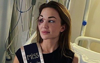 Gương mặt biến dạng của Hoa hậu Bỉ sau tai nạn xe hơi