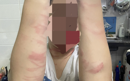 TP Hồ Chí Minh: Điều tra vụ thiếu nữ 17 tuổi bị mẹ đánh gây nhiều thương tích
