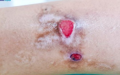 Kỳ lạ: Người phụ nữ ở TP.HCM tự cào rách da mỗi lần căng thẳng