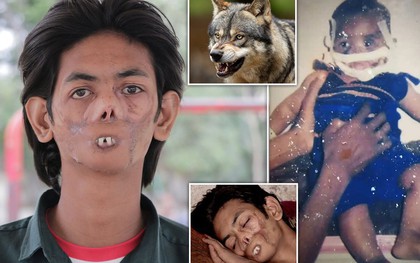 Bị sói tấn công từ khi còn nhỏ, chàng trai 18 tuổi bị dân làng xa lánh, gọi là "cậu bé ma" vì ngoại hình biến dạng khiến nhiều người xót xa