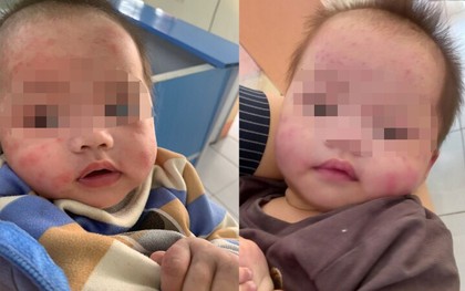 Bé gái 7 tháng tuổi bị bỏ rơi ven đường, gương mặt chi chít vết muỗi đốt