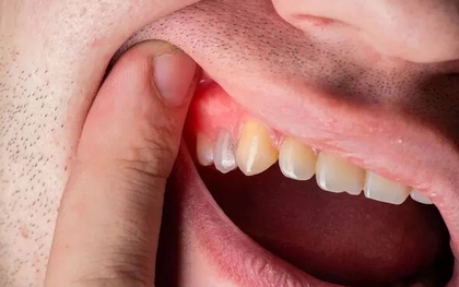 3 màu sắc ở răng là dấu hiệu cảnh báo căn bệnh dẫn đến rụng răng, thậm chí ung thư