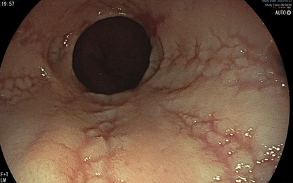Thực quản của người đàn ông trắng như da heo, sần sùi và lở loét vì sở thích ăn uống không hiếm gặp