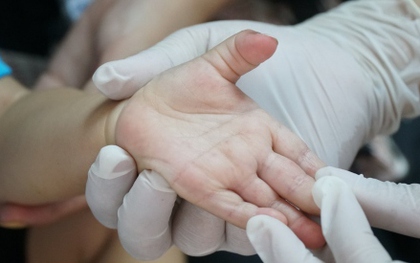 Một bệnh nhi ở Đắk Lắk tử vong vì tay chân miệng