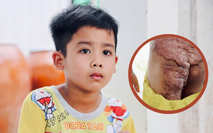 Xót xa cảnh bé trai 7 tuổi bị bỏng khắp người mà ông bà ngoại không có tiền chữa trị