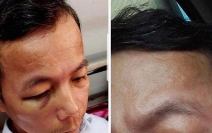 Đấm hiệu phó nhập viện, hiệu trưởng ở Quảng Bình bị kỷ luật cảnh cáo