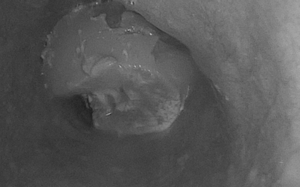 Người đàn ông suýt mất mạng vì cục gân bò 6 cm mắc trong thực quản