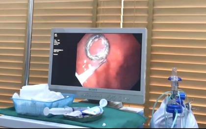 Bé trai nhập viện vì nuốt phải móc khóa