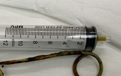 Phẫu thuật lấy thành công stent bị bỏ quên trong ống mật của cụ bà 77 tuổi suốt 6 năm