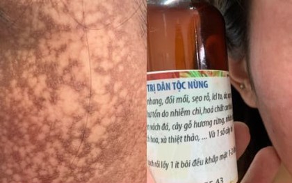 Mua mỹ phẩm trên mạng làm đẹp cấp tốc, nhiều người mất Tết vì biến chứng