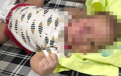 Công an vào cuộc vụ cháu bé 3 tháng tuổi bị đánh bầm tím mặt