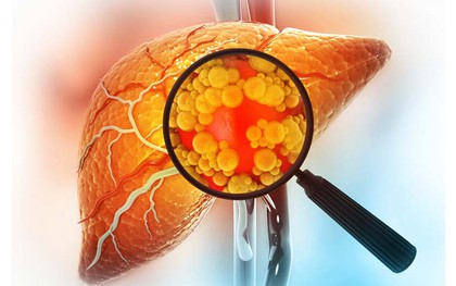 Bác sĩ 56 tuổi chia sẻ phương pháp 'đánh bại' gan nhiễm mỡ nhờ cắt giảm 3 món vạn người mê