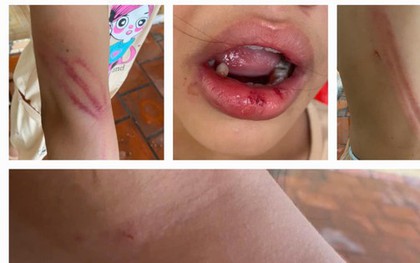 Bé gái 10 tuổi bị cha dượng đánh đập, người dân bức xúc báo công an