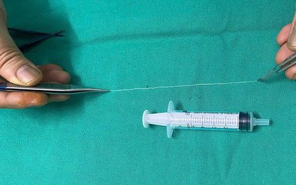 Bác sĩ gắp con giun dài 14 cm ký sinh trong mắt người phụ nữ ở Thanh Hóa