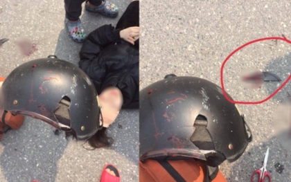 Cô gái ở Hà Nội bị mảnh vỡ của mũ bảo hiểm cắt vào đầu sau va chạm với xe ba gác