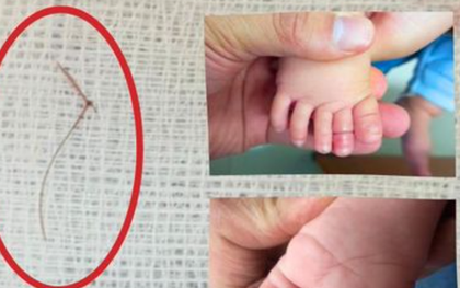 Sợi tóc thắt vào chân, bé gái 4 tháng tuổi suýt mất ngón