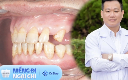 Mới 40 tuổi đã phải ăn đồ mềm như em bé do hệ luỵ của 1 thói quen tưởng chừng không làm mất răng