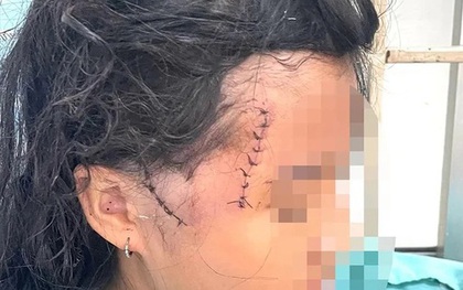 Mẹ và con gái bị người tình chém thương tích nhập viện