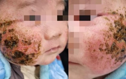 Người nhà tự đắp lá cây chữa viêm da, bé 4 tháng tuổi bị loét má nặng