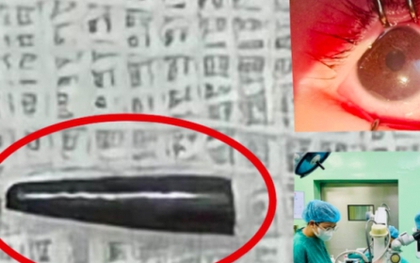 Ruột bút chì xuyên thủng nhãn cầu mắt của bé trai 9 tháng tuổi ở Nghệ An