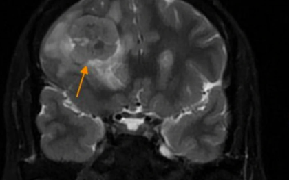 Đau nhức âm ỉ vùng trán, bất ngờ phát hiện khối u não nguy hiểm